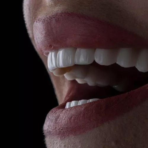 The Pros And Cons Of Dental Veneers