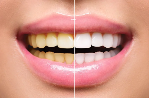 Tips For Professional Teeth Whitening Procedures