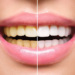 Tips For Professional Teeth Whitening Procedures