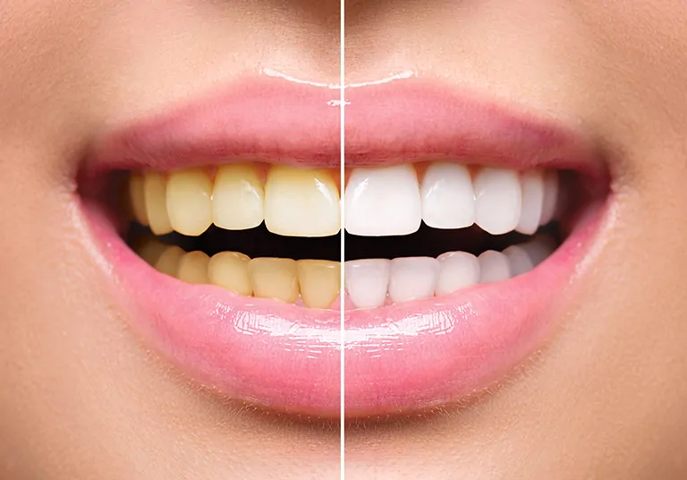 Tips For Professional Teeth Whitening Procedures